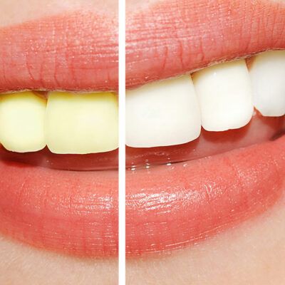 5 Easy Ways to Whiten and Brighten Teeth