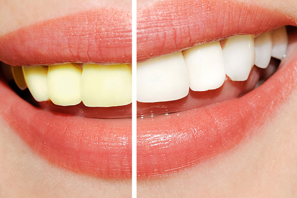 5 Easy Ways to Whiten and Brighten Teeth