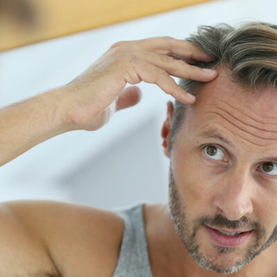 5 Ways to Manage Hair Loss in Men