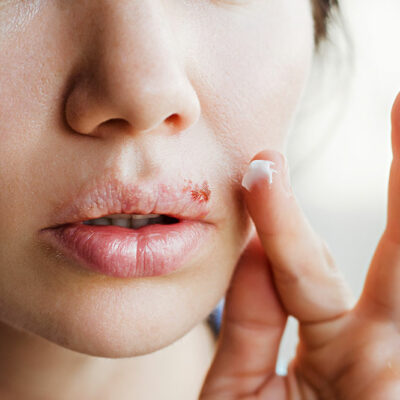 6 Common Cold Sore Causes