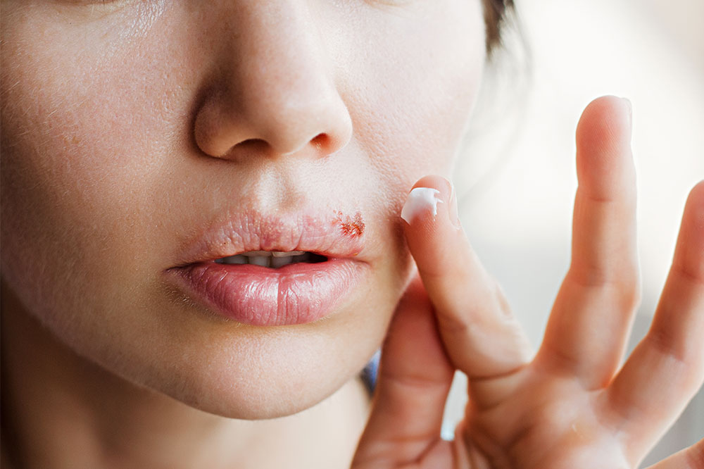 6 Common Cold Sore Causes